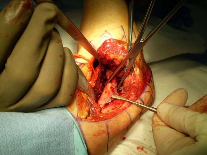 File:Heterotopic Ossification removal 2011.jpg