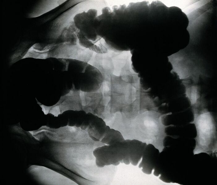 File:Amoebiasis; x-ray of colon. Photograph, 1930. Wellcome V0047842.jpg