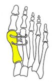 Cerclage bone sutures