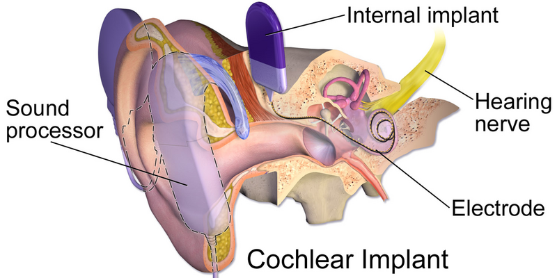 File:Cochlear Implant.png
