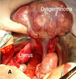 Dysgerminoma surgery.jpg