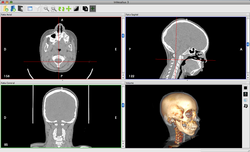 Invesalius3 promed0446.png