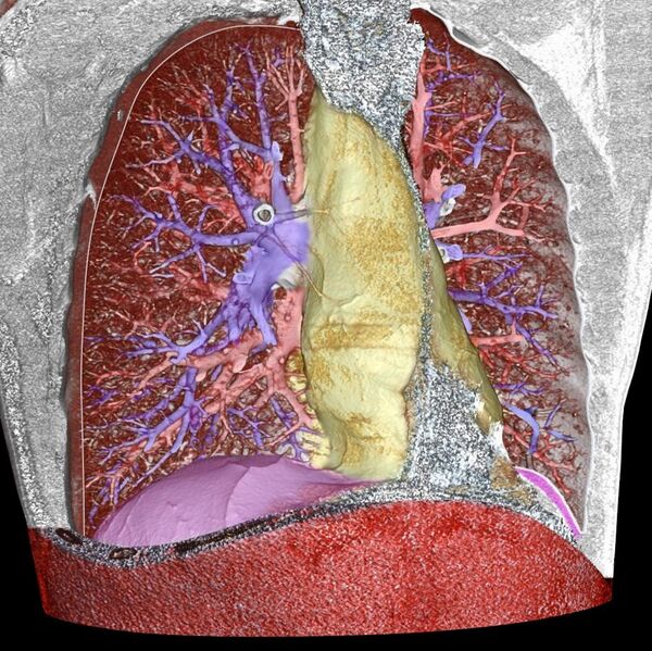 File:3D CT of thorax.jpg