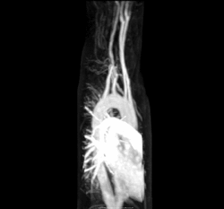 Arteria-lusoria MRA MIP.gif