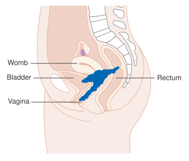 File:Diagram showing stage 4A cervical cancer CRUK 236.svg