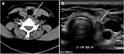 CT and ultrasonography of residual normal thyroid tissue after thyroidectomy.jpg