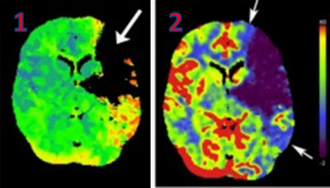 CT perfusion with flow and volume maps in cerebral infarction.png
