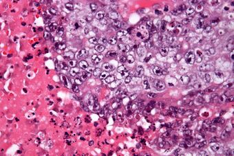 Embryonal carcinoma - very high mag - cropped.jpg