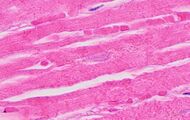 Histopathology of myocardial infarction with loss of nuclei.jpg