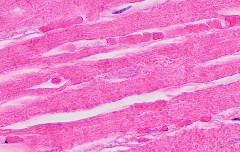 File:Histopathology of myocardial infarction with loss of nuclei.jpg