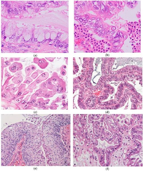 File:Histopathology of seromucinous borderline tumors.jpg