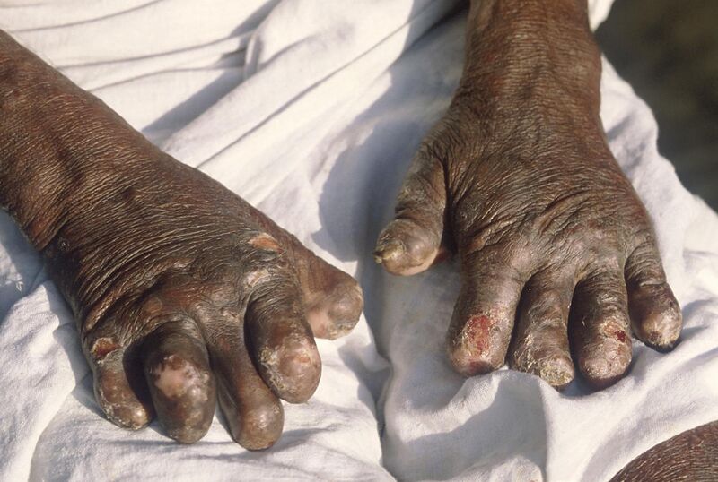File:Leprosy deformities hands.jpg