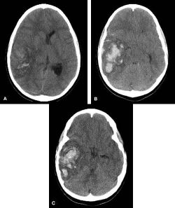 Multiple intraparenchymal hemorrhage.jpg