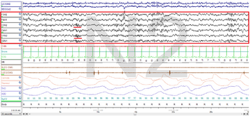 Stage N2 Sleep. EEG highlighted by red box. Sleep spindles highlighted by red line.