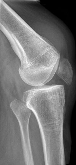 Quadriceps Ruptur Roe1.jpg