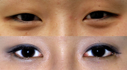 Example of Korean double eyelid surgery