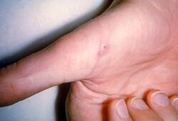 A lesion on the hand of a patient with cat-scratch disease.