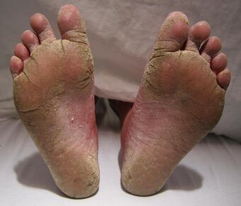 FeetFungal.JPG