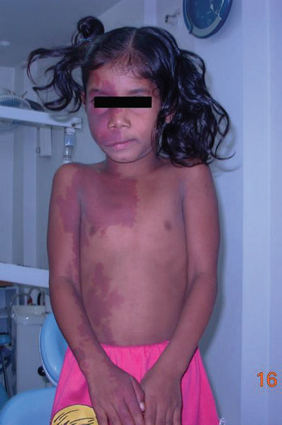 File:Port wine stains of an 8-year-old female with Sturge-Weber Syndrome.png