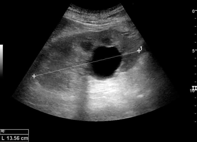 File:Simple cyst with posterior enhancement.jpg
