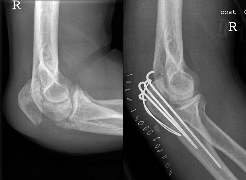 File:Fracture of Olecranon pre and post typical surgery.jpg