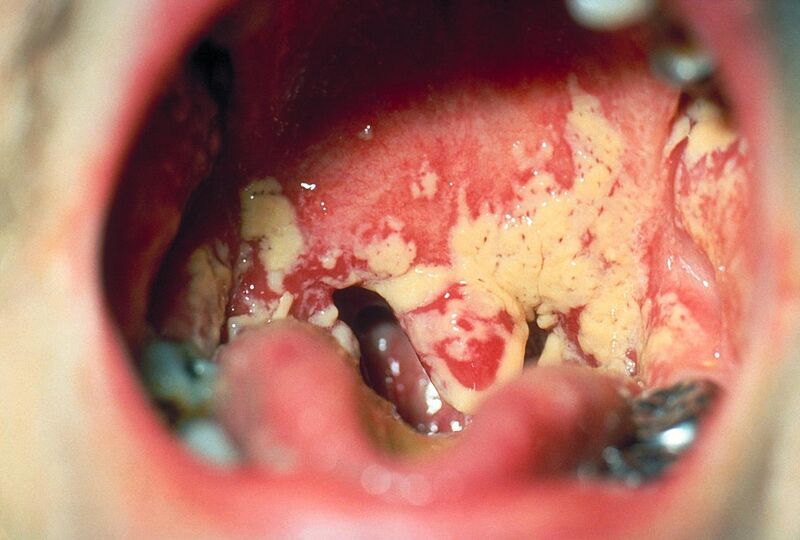 File:Oral thrush Aphthae Candida albicans. PHIL 1217 lores.jpg