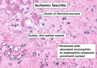 Histopathology of ischemic fasciitis.png