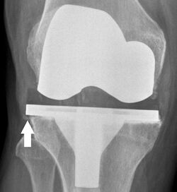 X-ray of knee prosthesis with overhang, annotated.jpg