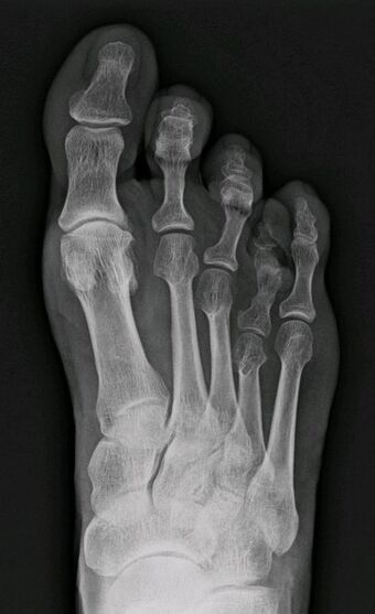 Brachymetatarsia, fourth metatarsal bone, X-ray.jpg