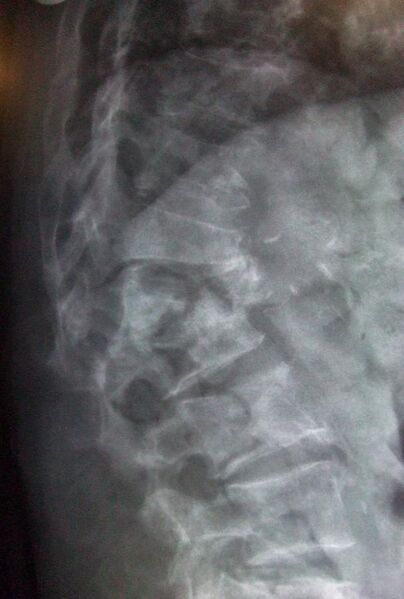 File:L1 2 vertebral fracture.jpg