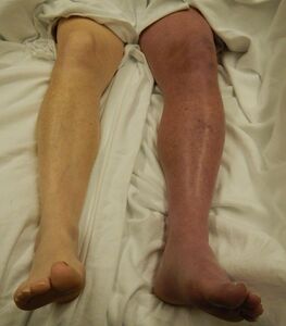 Image showing marked discoloration of a leg with phlegmasia cerulea dolens