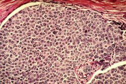 Breast cancer cells.jpg