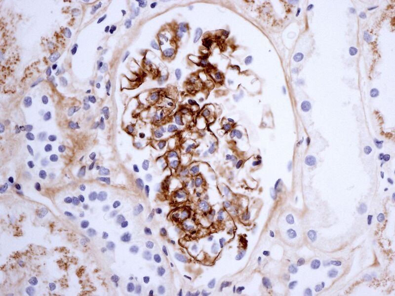 File:Henoch-Schönlein nephritis IgA immunostaining.jpg