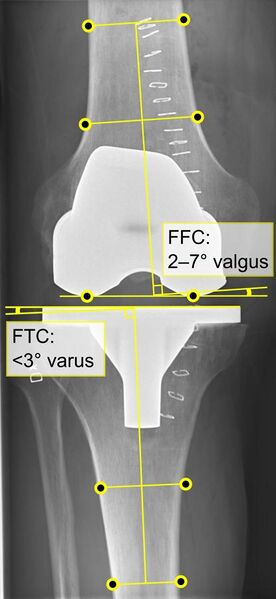 File:Postoperative X-ray of normal knee prosthesis, anteroposterior view, annotated.jpg