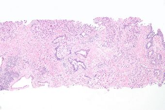 Urethral urothelial cell carcinoma.jpg