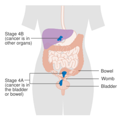 Diagram showing stage 4A and 4B cancer of the womb CRUK 234.svg