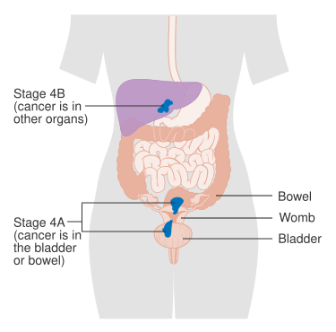File:Diagram showing stage 4A and 4B cancer of the womb CRUK 234.svg