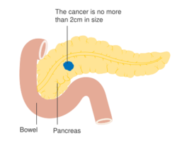 Diagram showing stage T1 cancer of the pancreas CRUK 246.svg