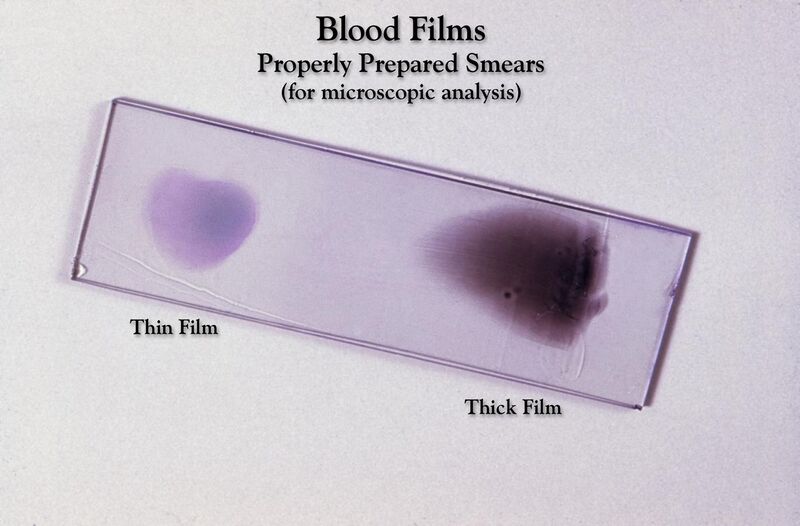 File:Blood film 01.jpg