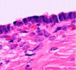 Histopathology of serous cystadenoma.jpg