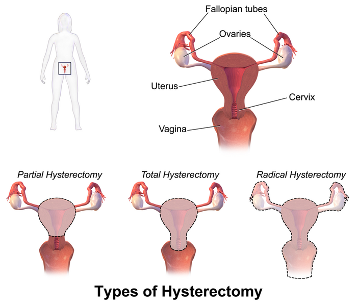 File:Hysterectomy.png