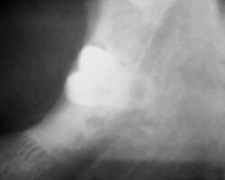 Radiograph of impacted wisdom tooth near nerve.jpg