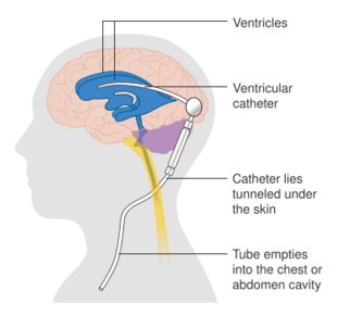 Diagram showing a brain shunt CRUK 052.svg