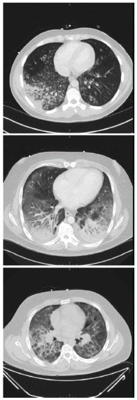 E cig tomography of chests mm6836e1-F1.gif