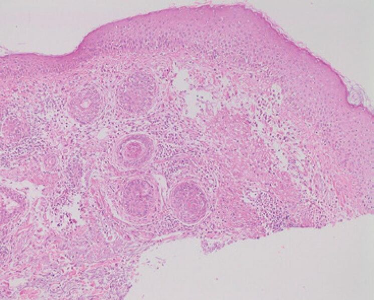 File:Micrograph of rosacea.jpg
