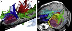 3DSlicer-Mislow-NeurosurgClinNAm2009-fig3.jpg