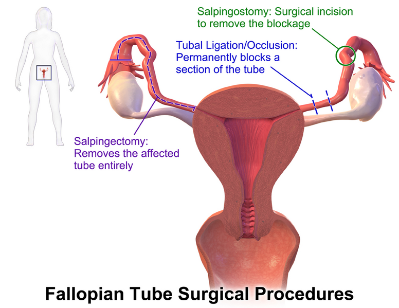 File:Fallopian Tube Surgical Procedures.png