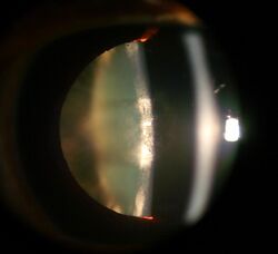 Anterior subcapsular cataract.jpg