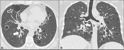 CT of lymphocytic interstitial pneumonia.jpg