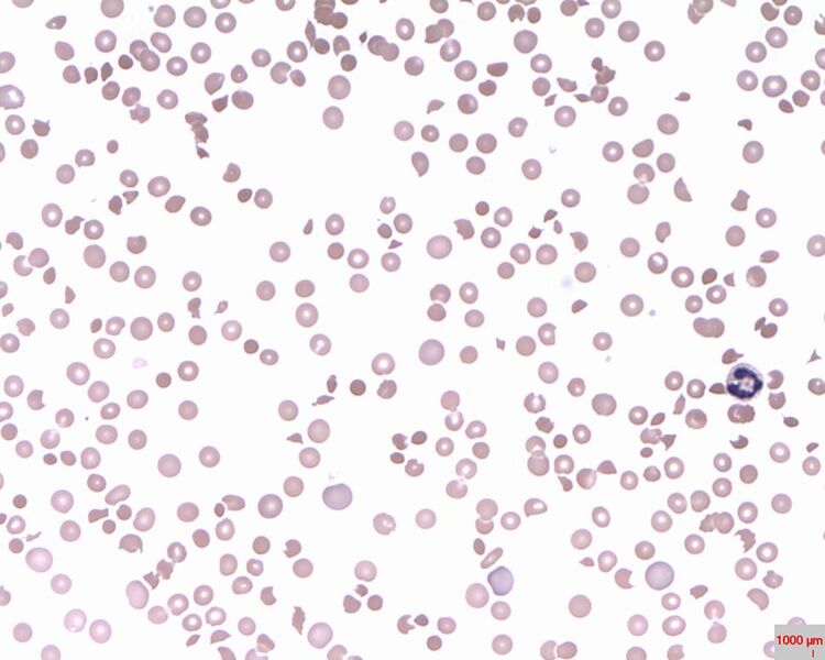 File:Thrombi in patient with thrombotic thrombocytopenic purpura .jpg